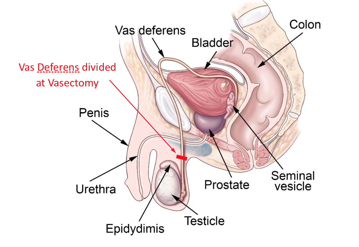 Vasectomy – Highlands Vasectomy Clinic